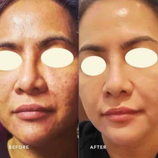 3 PDRN Microneedling Sessions at Rejuva Glow Beauty in Bethesda, MD