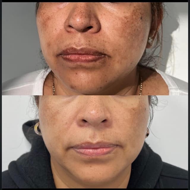 6 Microneedling Depigmenting Sessio at Rejuva Glow Beauty in Bethesda, MD