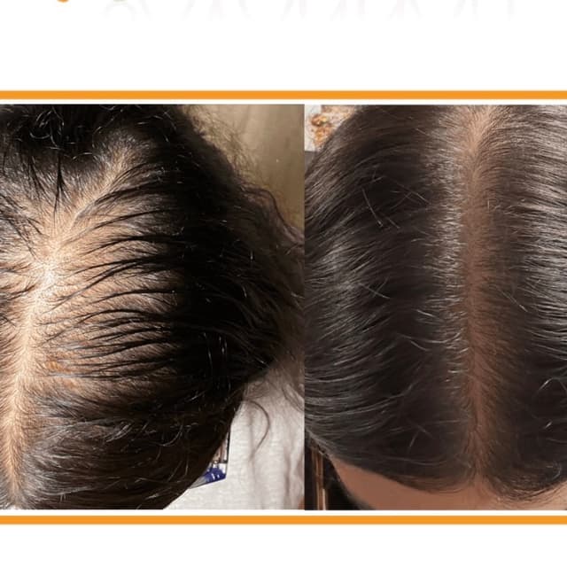 6 Hair Restorative Microneedling at Rejuva Glow Beauty in Bethesda, MD