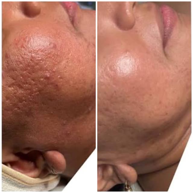 4 Microneedling Glow +Tone Sessions at Rejuva Glow Beauty in Bethesda, MD