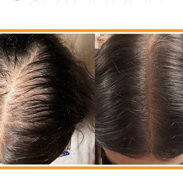 3 Hair Restoration Microneedling at Rejuva Glow Beauty in Bethesda, MD